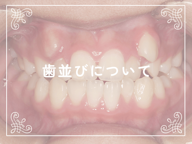 歯並びについて